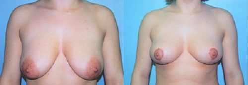 Areola reduction procedure in Sydney