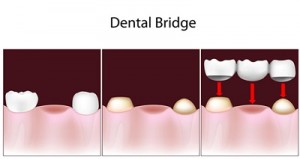 Dental bridge