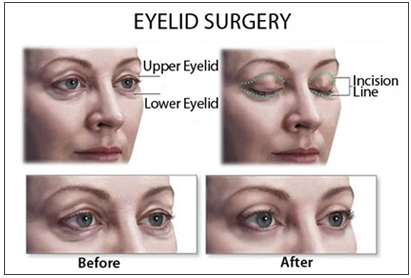 Eyelidsurgery_sydney