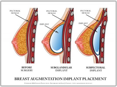 breast implant placment