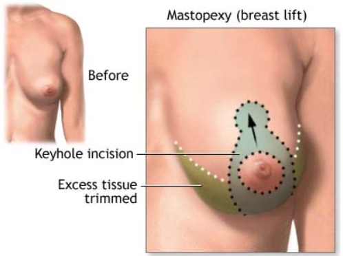 breast lift procedure sydney