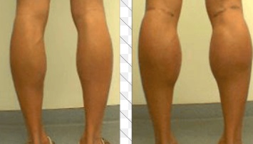 calf implants