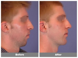 chin-implant