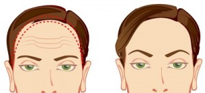 face lift procedure in Sydney