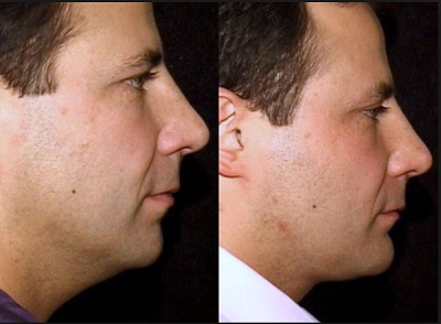 neck lift procedure in Sydney