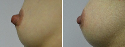 nipple reduction procedure in Sydney