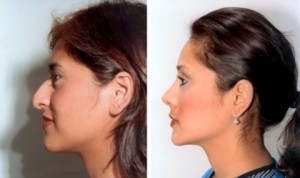 nose job in sydney