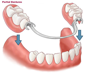 partial-dentures-small10