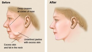 plastic surgery abroad face lift procedure