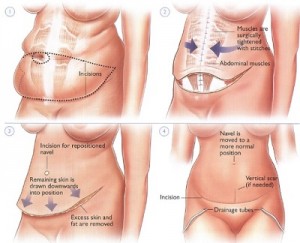 abdominalplasty-explained