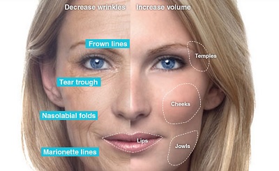 dermal-fillers