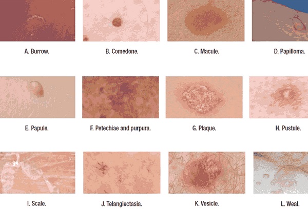 skin lesions