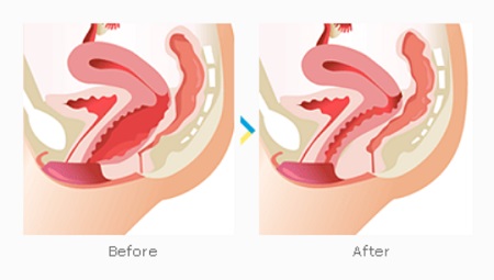 vaginal-tightening-surgery-before-and-after