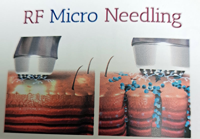 RF Micro Needling