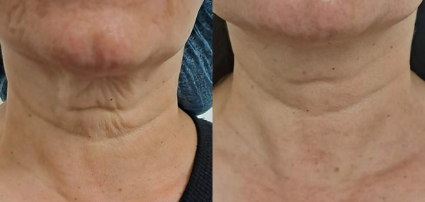 Non Surgical Neck Lift